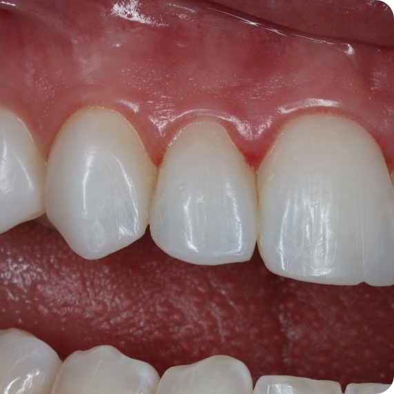 Close up of teeth after correcting shortness and gaps