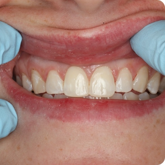 Dentist moving a patient's upper lip to reveal flawless front teeth