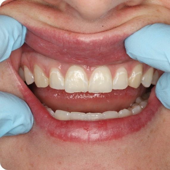 Dentist moving a patient's upper lip to reveal chipped front teeth