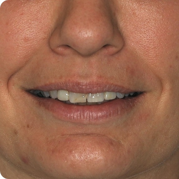 Close up of smile with discolored teeth