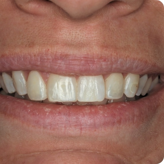 Close up of smile with brighter teeth