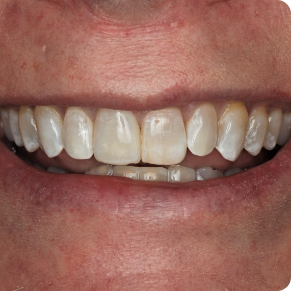 Close up of smile after fixing chipped and slightly gapped front teeth