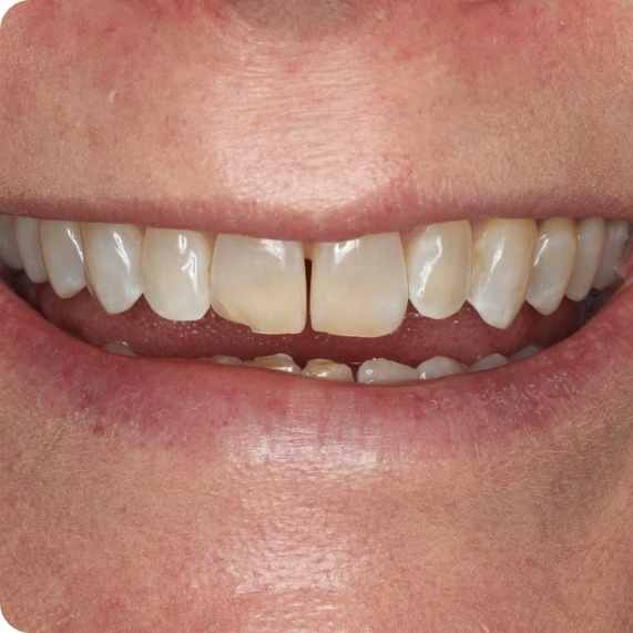 Close up of smile with chipped and slightly gapped front teeth