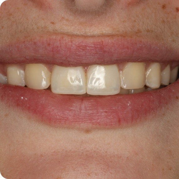 Close up of smile with imperfect teeth