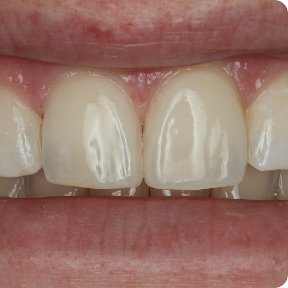 Close up of flawless teeth after dental treatment