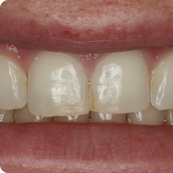 Close up of imperfect teeth