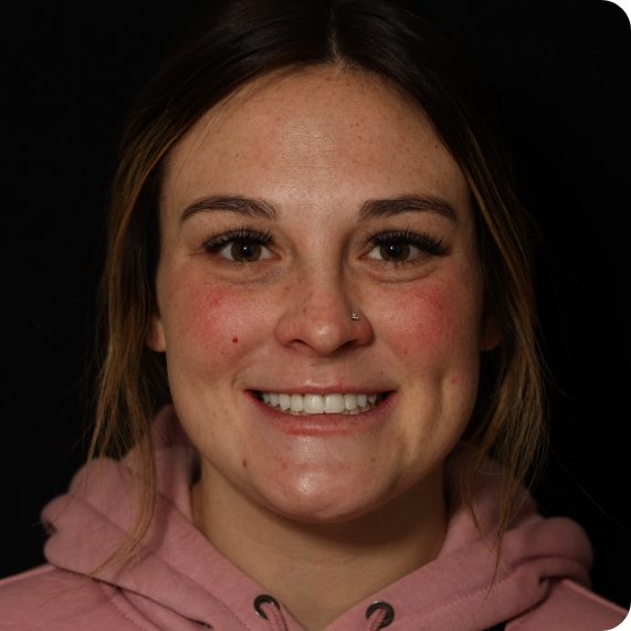 Young woman smiling after whitening her teeth