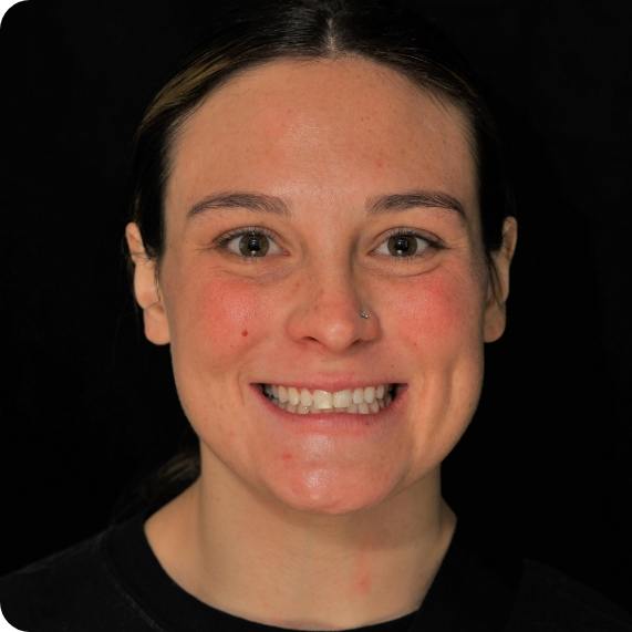 Young woman smiling with slightly discolored teeth