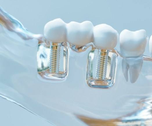 Model of the jaw with two dental implants supporting a dental bridge