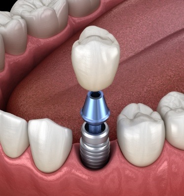 Animated dental implant with dental crown