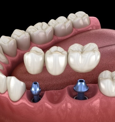 Animated dental bridge supported by two dental implants
