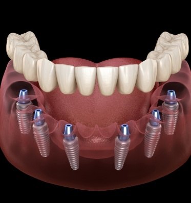 Animated implant denture in the lower jaw