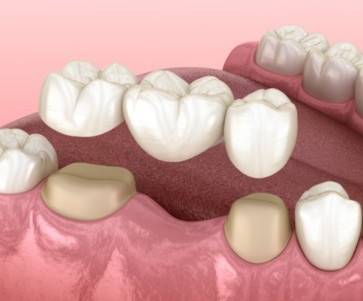 Animated dental bridge replacing a missing tooth