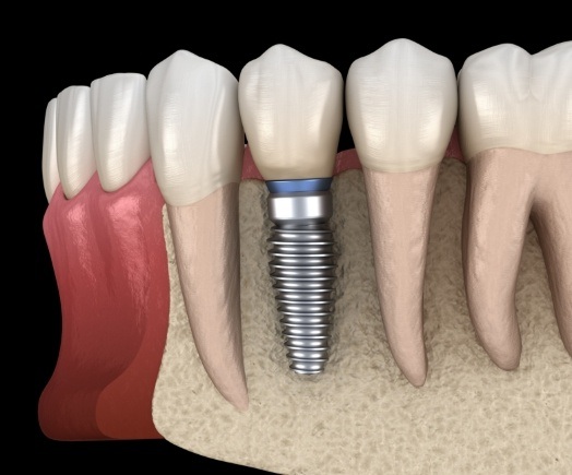 Animated dental implant replacing a missing tooth in the lower jaw