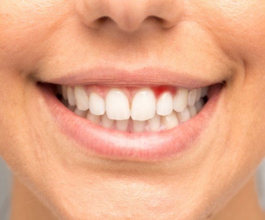  Close up of smile with red areas in gums