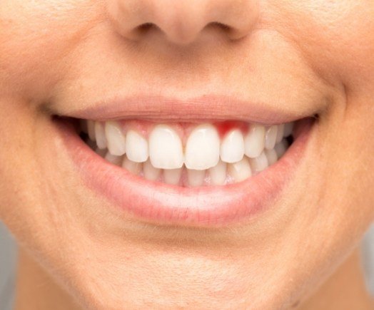 Close up of smile with red areas in gums