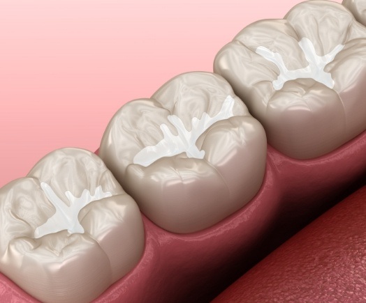 Animated row of teeth with dental sealants