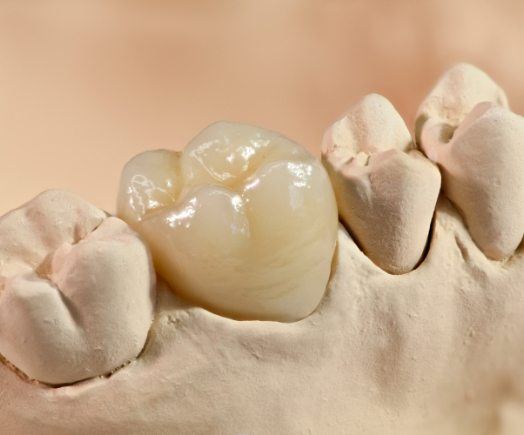 Dental crown resting on tooth in model of mouth