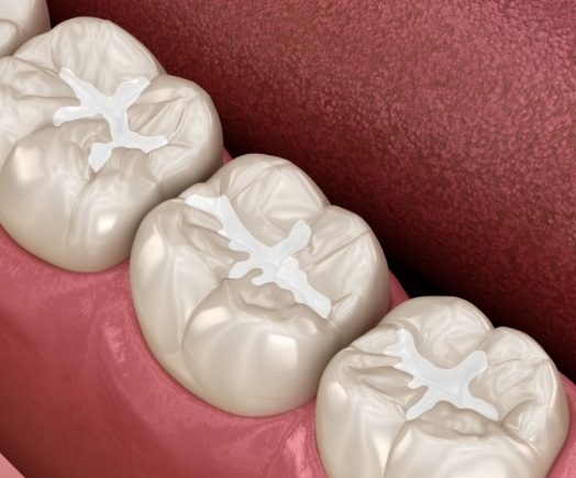 Animated row of teeth with tooth colored fillings