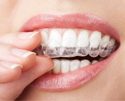 a closeup of a whitening tray