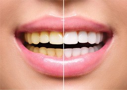 a side-by-side comparison of whitened teeth