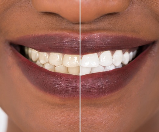 Closeup of patient's teeth before and after teeth whitening
