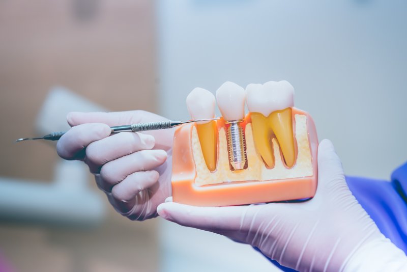 Dentist explaining dental implants
